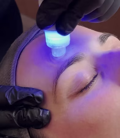 Anti Ageing Treatments for Wrinkles, Skin Laxity & Collagen Loss